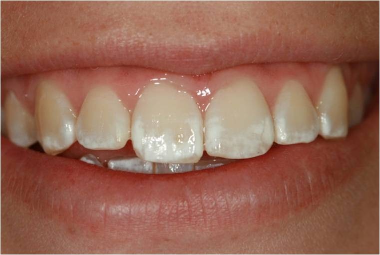 Manchas blancas en los dientes